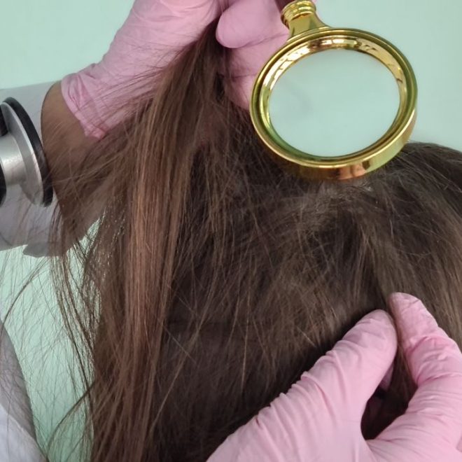 Dermite séborrhéique sur le cuir chevelu : Traitements naturels !