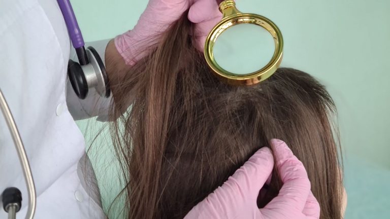 Dermite séborrhéique sur le cuir chevelu : Traitements naturels !