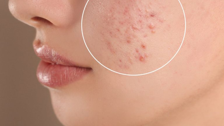 Comprendre l&rsquo;acné hormonale et mes conseils en Bonus