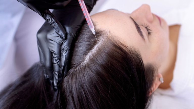 PRP Cheveux : indications et déroulement du traitement